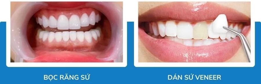 Răng thỏ – Xu hướng thẩm mỹ răng mới tại Nha khoa 5Brothers 4 lam-rang-tho-dep