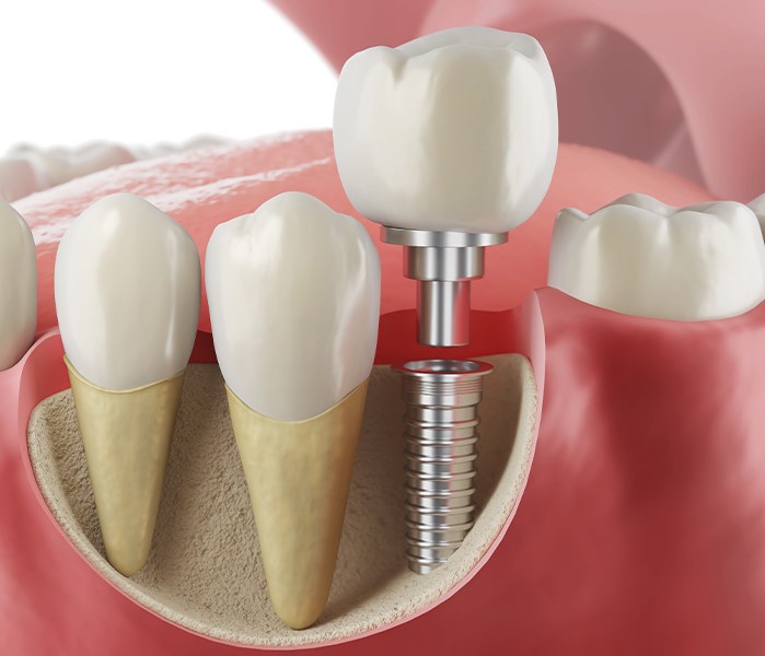 Cay ghep implant la phuong phap phuc hinh rang mat toi uu nhat hien nay