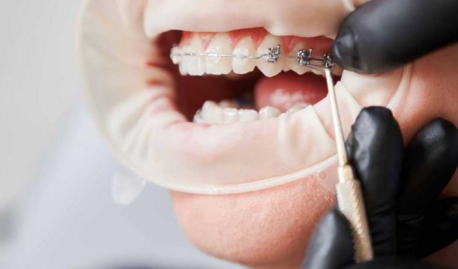 Trước Khi Niềng Răng Cần Chuẩn Bị Gì? 1 Chon-nha-khoa-uy-tin-giup-han-che-nhung-bien-chung