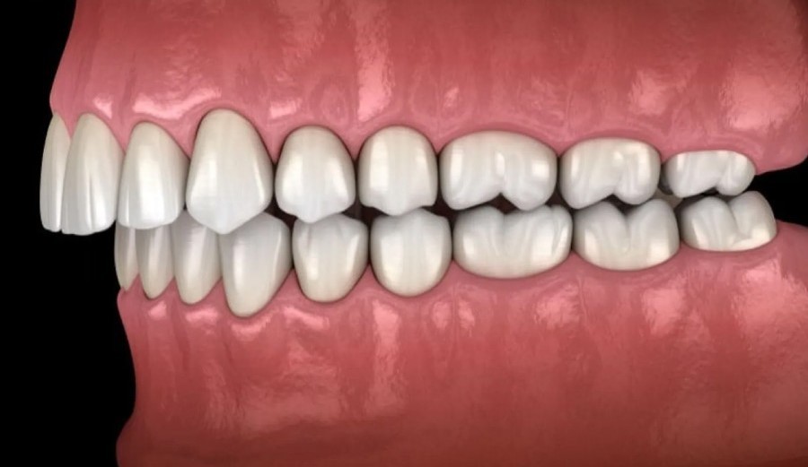 Niềng Răng Vẩu Mất Bao Lâu? Giá Bao Nhiêu Tiền? 1 rang-vau-la-gi