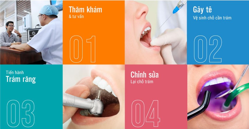 Trám răng thẩm mỹ giải pháp khôi phục răng sâu, mẻ, vỡ 3 quy-trinh-tram-rang