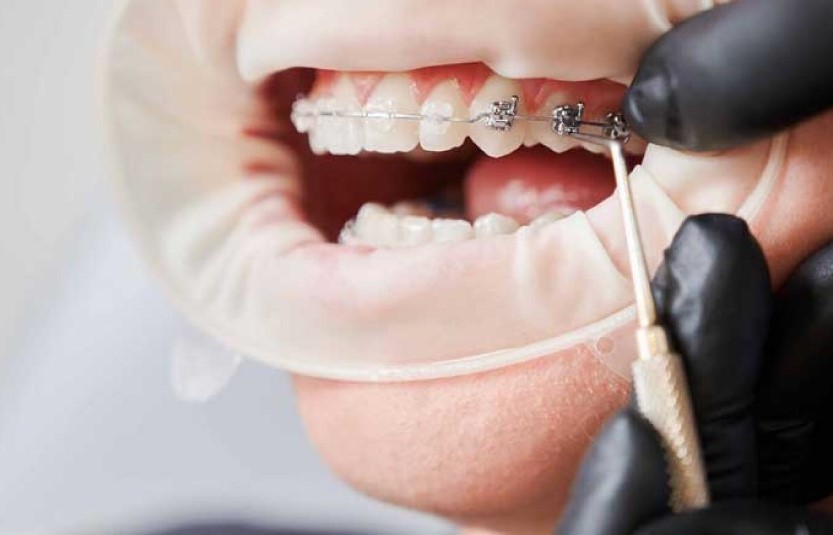 Giải Đáp: Bao Nhiêu Tuổi Thì Không Niềng Răng Được Nữa? 1 do-tuoi-khong-nieng-rang-duoc