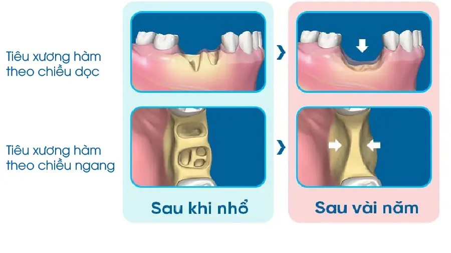 Tiêu xương răng là gì? Dấu hiệu, nguyên nhân và cách phòng ngừa 1 tieu-xuong-rang-va-giai-phap