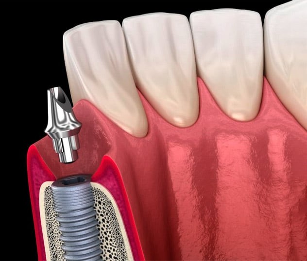 abutment implant 1 8951a48fb2774ad2b3677bfefe81d041