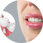 Bọc răng sứ 3 an toan