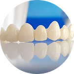 Bọc răng sứ 4 ben vung