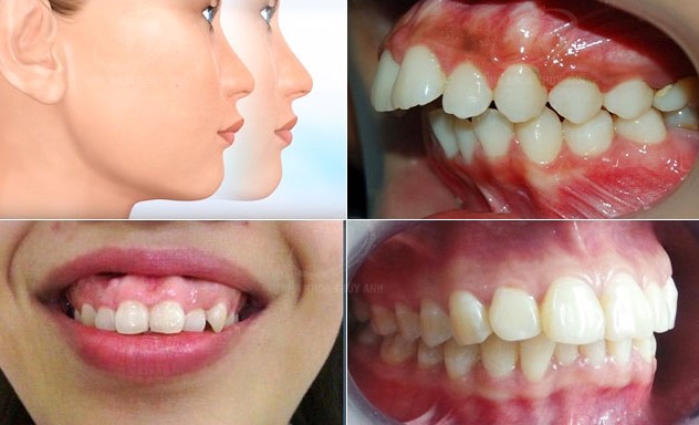 Niềng Răng Vẩu Mất Bao Lâu? Giá Bao Nhiêu Tiền? 2 rang-vau-co-3-dang