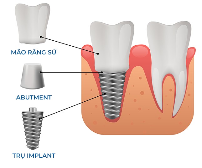 cau tao 1 chiec rang implant