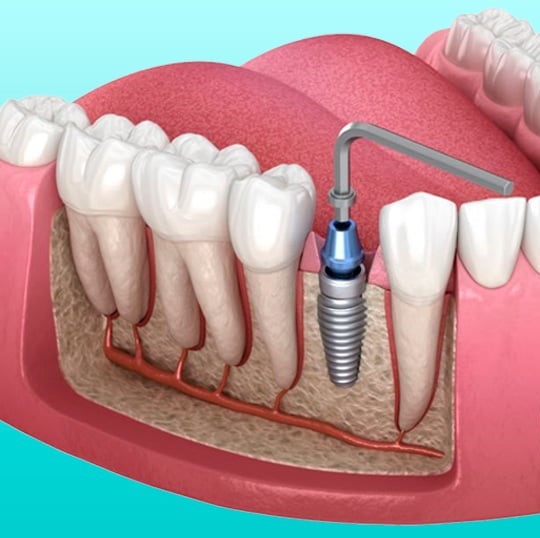 chong chi dinh trong rang implant