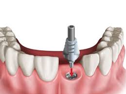 Cấy ghép implant có đau không? Thời gian hồi phục? 2 trong-rang-tai-nha-khoa-5-brothers