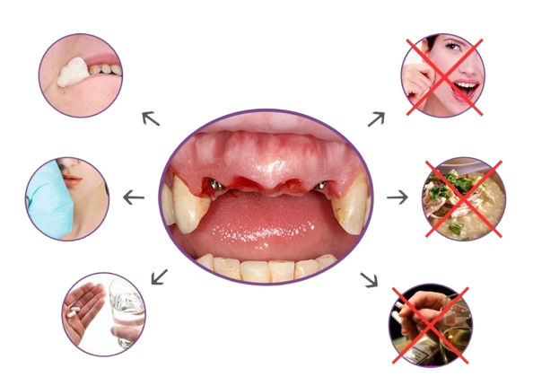 implant 1 removebg preview