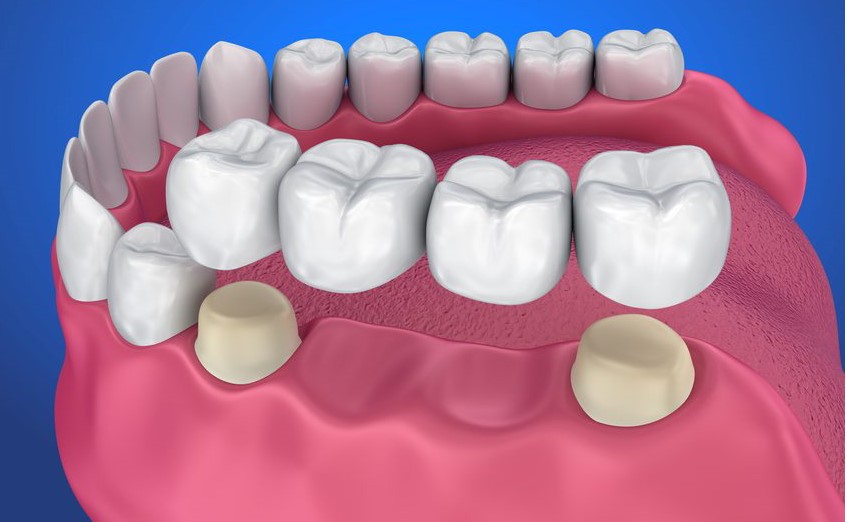 Nhược Điểm Của Việc Bọc Răng Sứ Và Nguy Cơ Tiềm Ẩn 1 boc-rang-su-giup-cau-thien-tham-my