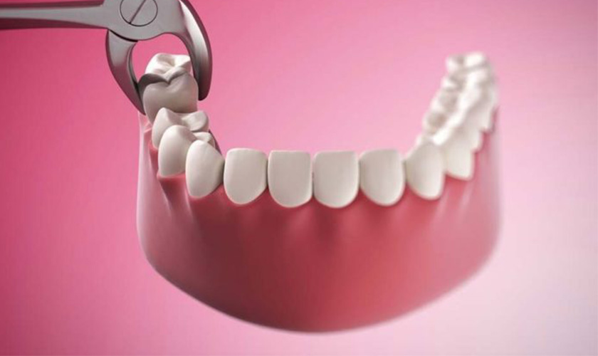 Nhổ răng an toàn, không đau, không biên chứng, hồi phục nhanh 3 nho-rang-tai-nha-khoa