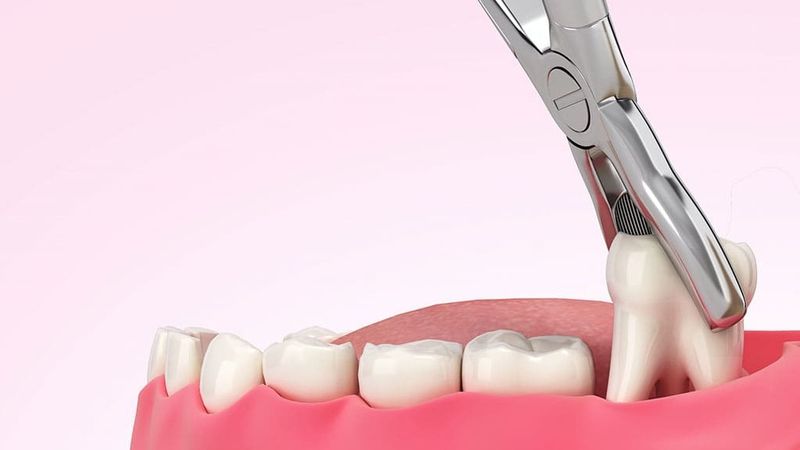 Nhổ răng an toàn, không đau, không biên chứng, hồi phục nhanh 1 nho-rang