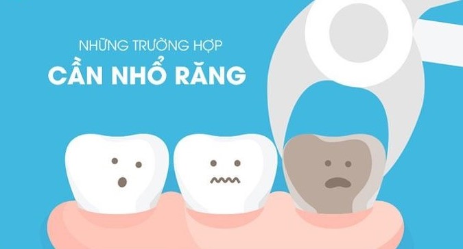 Nhổ răng an toàn, không đau, không biên chứng, hồi phục nhanh 2 nho-rang-duoc-chi-dinh