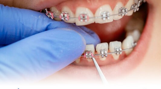 Nha Khoa 5BROTHERS Tri ân 15% dịch vụ Niềng răng mắc cài 2 tai-sao-nen-nieng-rang