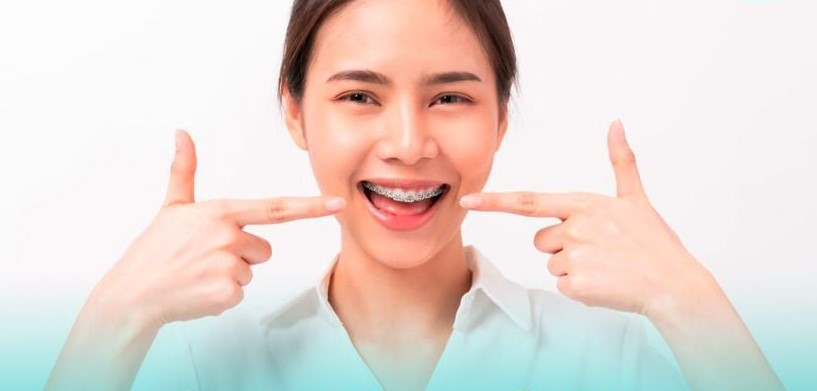 Giải Đáp: Bao Nhiêu Tuổi Thì Không Niềng Răng Được Nữa? 4 nieng-rang-hieu-qua