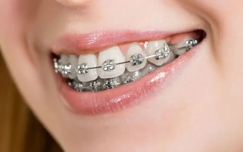 Niềng Răng Vẩu Mất Bao Lâu? Giá Bao Nhiêu Tiền? 5 nieng-rang-vau-bao-lau