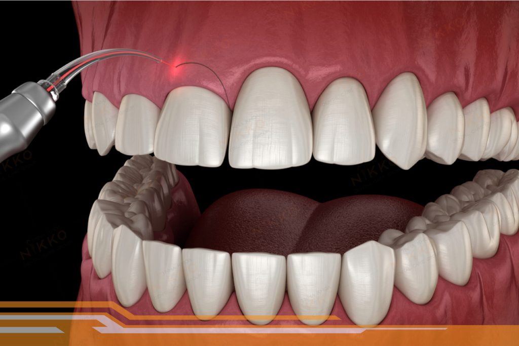 Tạo hình nướu răng là gì? Vì sao nên thực hiện sớm? 1 tao-hinh-nuou