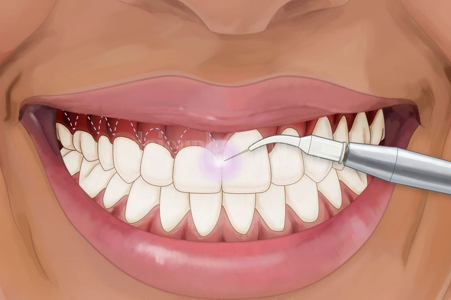 Tạo hình nướu răng là gì? Vì sao nên thực hiện sớm? 2 phau-thuat-tao-hinh-nuou