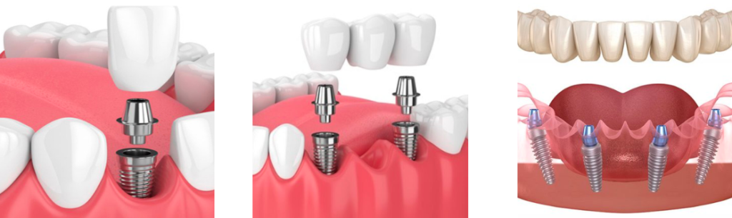 phuong phap trong rang