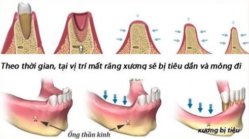Tiêu xương răng là gì? Dấu hiệu, nguyên nhân và cách phòng ngừa 2 dau-hieu-nhan-biet-tieu-xuong-rang