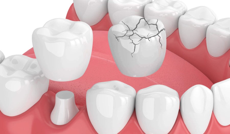 Nhược Điểm Của Việc Bọc Răng Sứ Và Nguy Cơ Tiềm Ẩn 2 boc-rang-su-kem-chat-luong