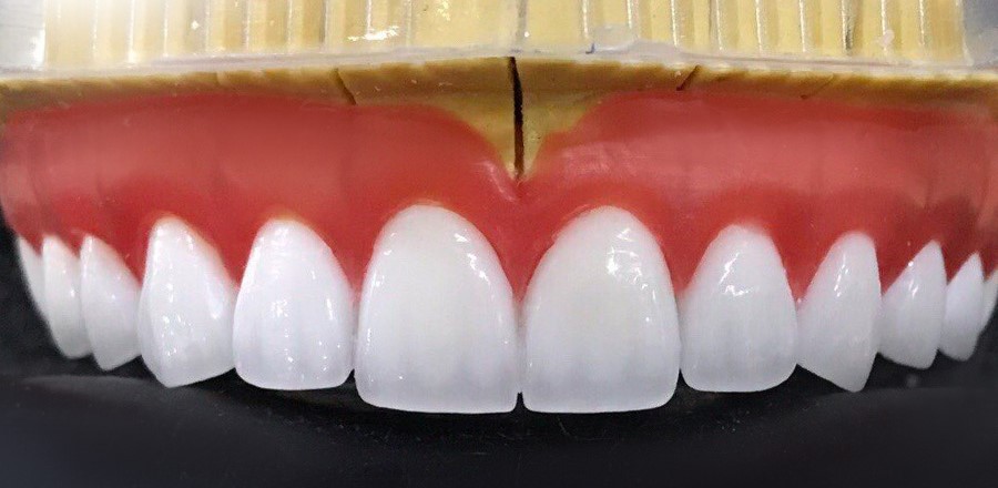 Răng Sứ Lava Plus Là Gì? Ưu Nhược Điểm? Giá Bao Nhiêu? 2 rang-su-lava-plus