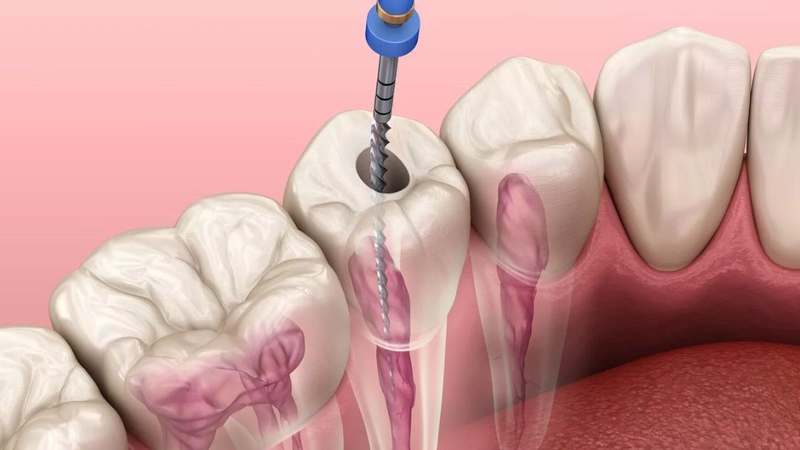 Lấy Tủy Răng Có Tiêm Thuốc Tê Không? 4 dieu-tri-tuy-an-toan