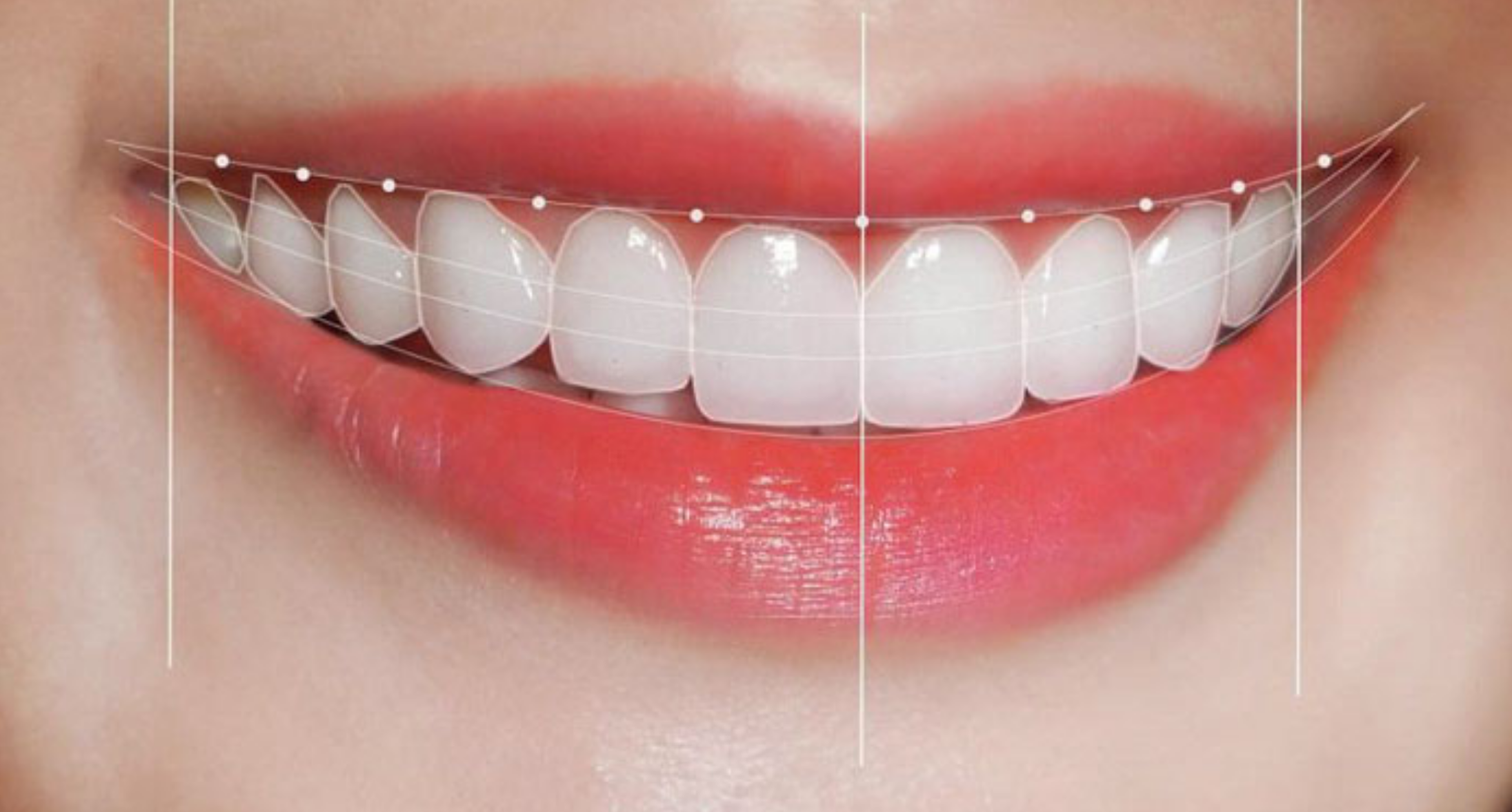 Răng thỏ – Xu hướng thẩm mỹ răng mới tại Nha khoa 5Brothers 2 dang-rang-tho-ty-le-dep