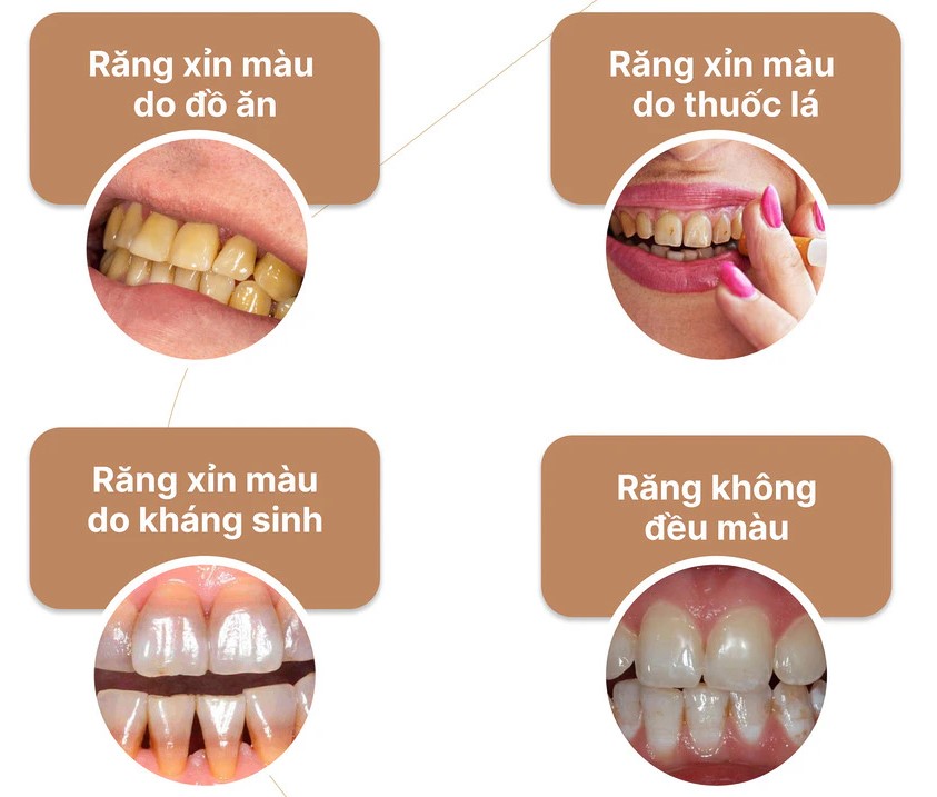 Giải pháp làm trắng răng an toàn tại Nha khoa 5BROTHERS 3 doi-tuong-nen-tay-trang-rang