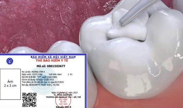 tram rang co duoc bao hiem y te khong 1 1