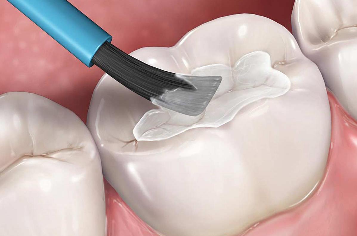 Trám răng thẩm mỹ giải pháp khôi phục răng sâu, mẻ, vỡ 1 tram-rang-tham-my