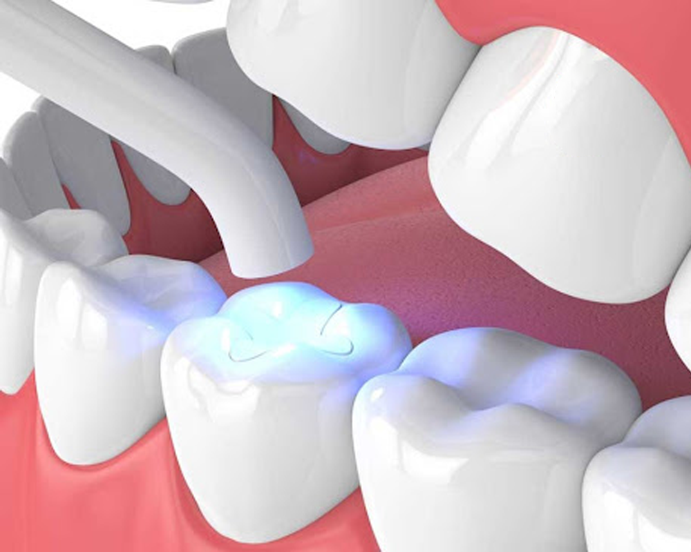 Trám răng thẩm mỹ giải pháp khôi phục răng sâu, mẻ, vỡ 4 tram-rang-giu-duoc-bao-lau