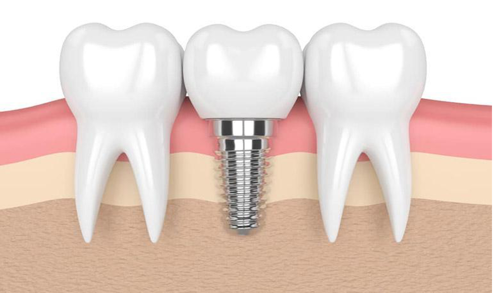 Cấy ghép implant có đau không? Thời gian hồi phục? 1 trong_rang_co_dau_khong