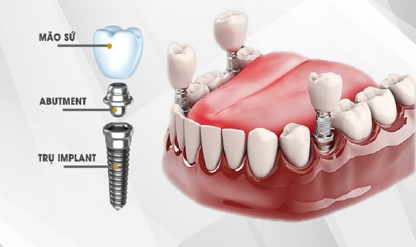 trong rang implant la gi can luu y gi khi trong rang implant 1