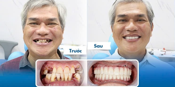 tru implant detium han quoc 1 8